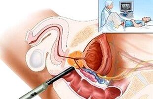 Spôsoby diagnostikovania prostatitídy