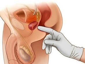 Masáž prostaty na liečbu prostatitídy u mužov