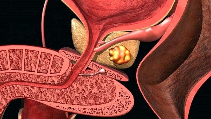 Kamenné usadeniny v prostate s kalkulóznou prostatitídou