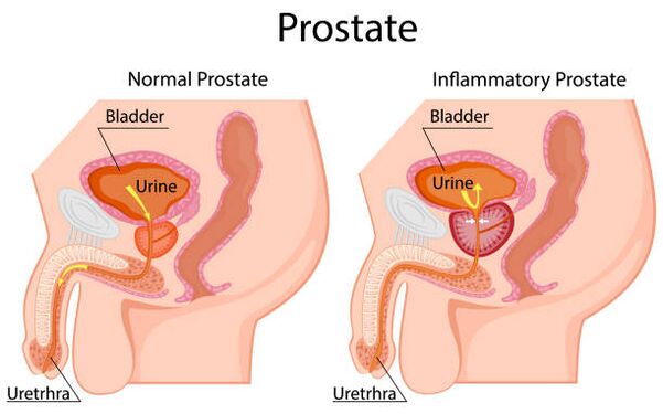 zdravá a zapálená prostata