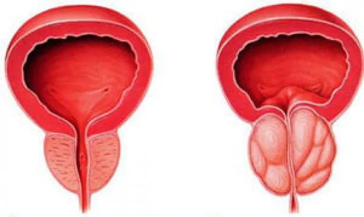 Normálna prostata (vľavo) a zapálená chronická prostatitída (vpravo)
