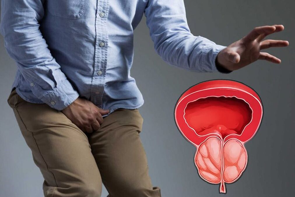 akútna prostata u mužov